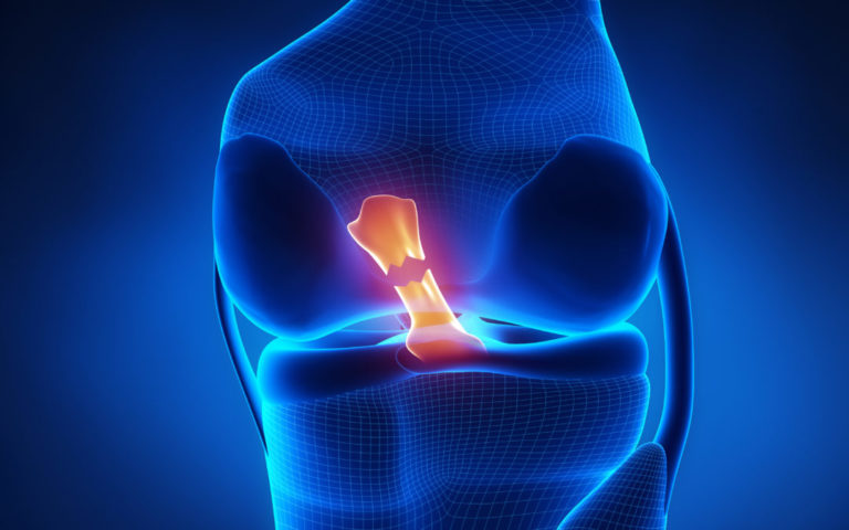 What's Best for ACL Tear — Repair or Reconstruction? - Training ...