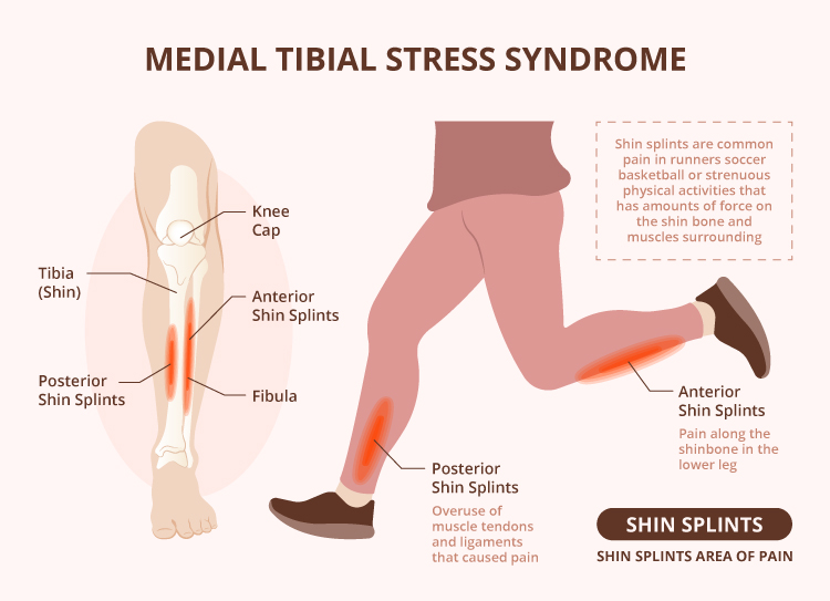 Exercises for Medial Tibial Stress Syndrome (AKA 'Shin Splints') -  RunningPhysio